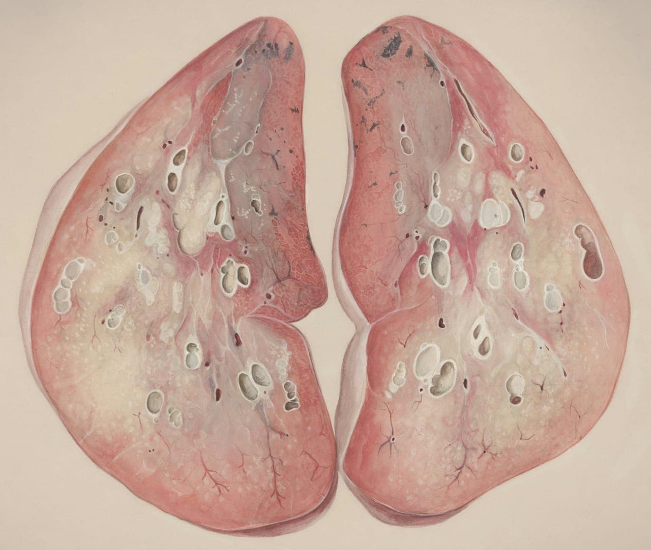 Rare diseases